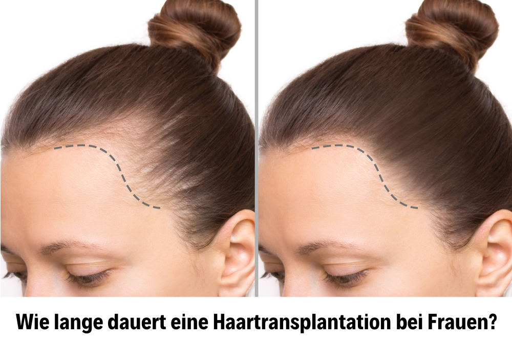 Haartransplantation für Frauen